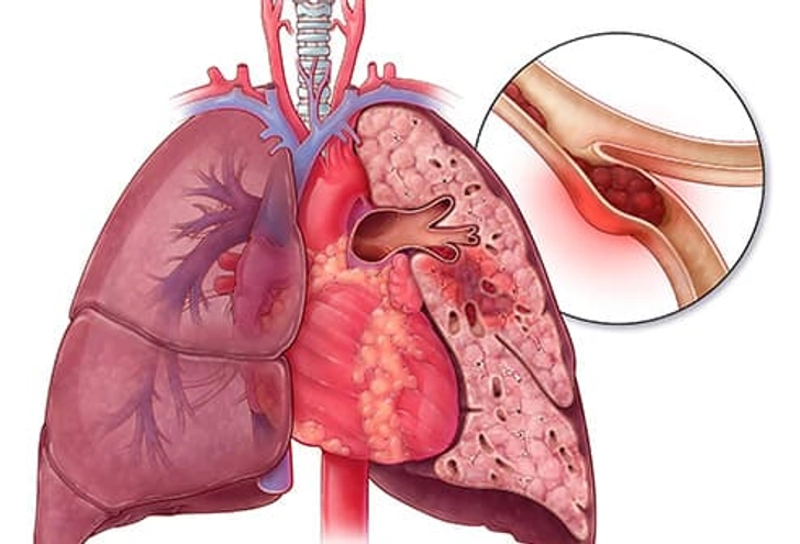 Pulmonary Embolism (PE)