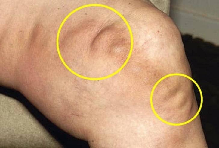 Thrombophlebitis