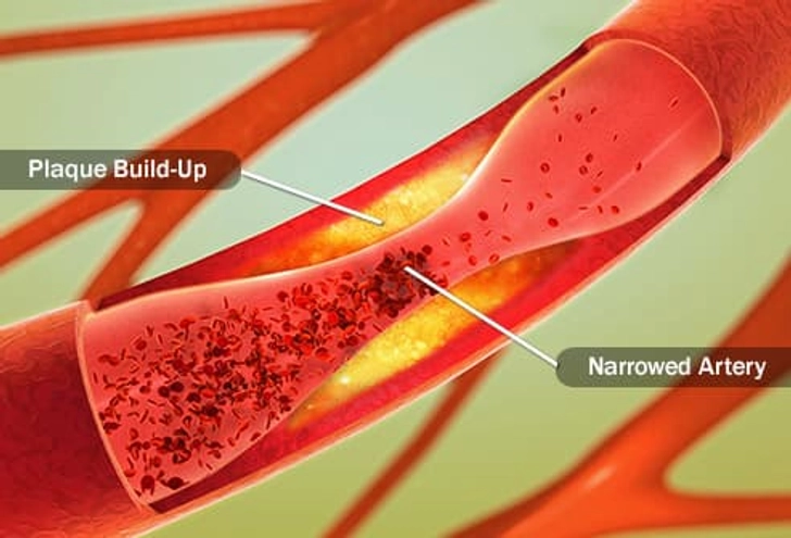 Coronary Artery Disease