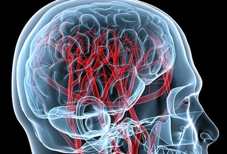 Cerebrovascular Diseases