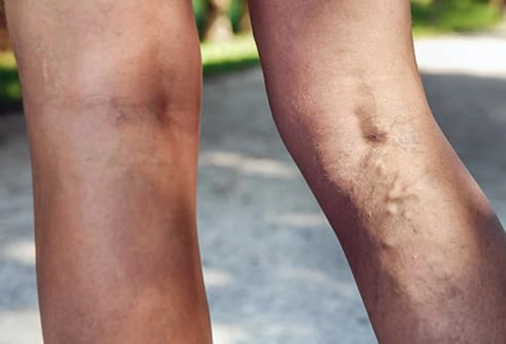 Varicose Veins