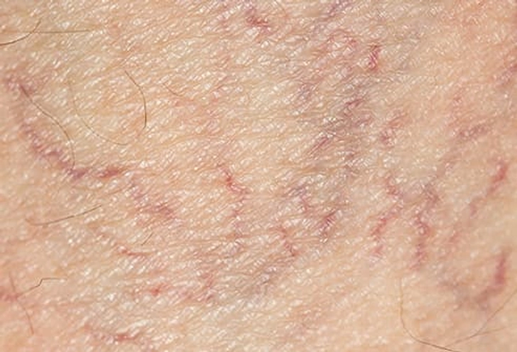 Spider Veins