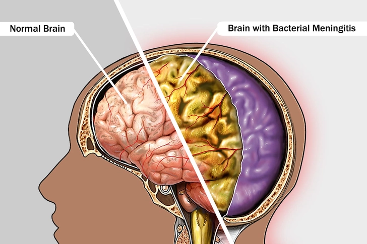 Bacterial Meningitis