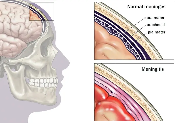 What Is Meningitis? What Is Meningitis?
