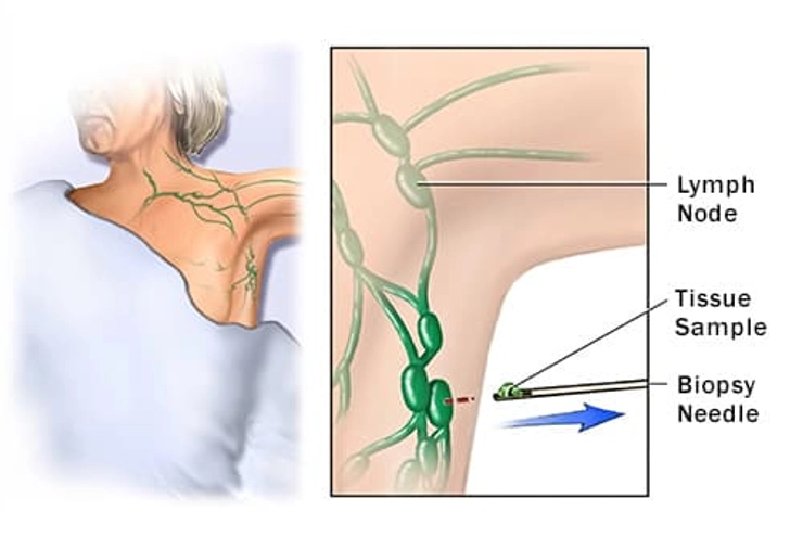Biopsy
