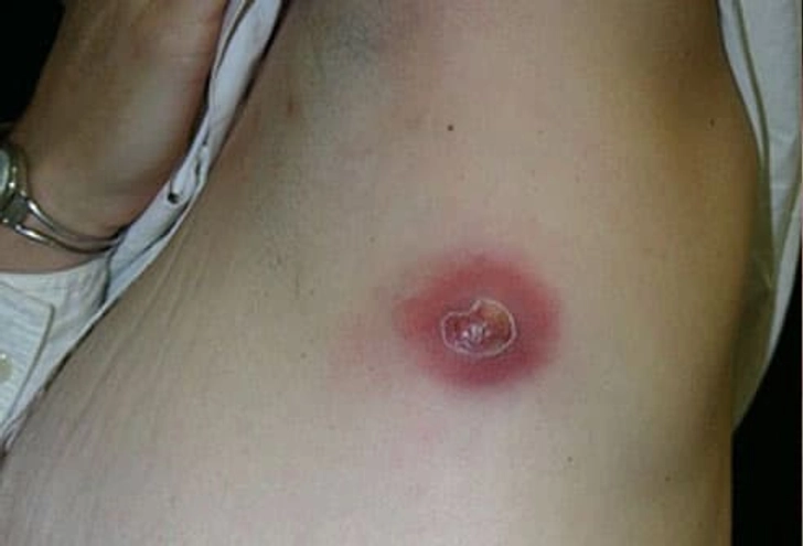 Boil Type: Armpit and Groin