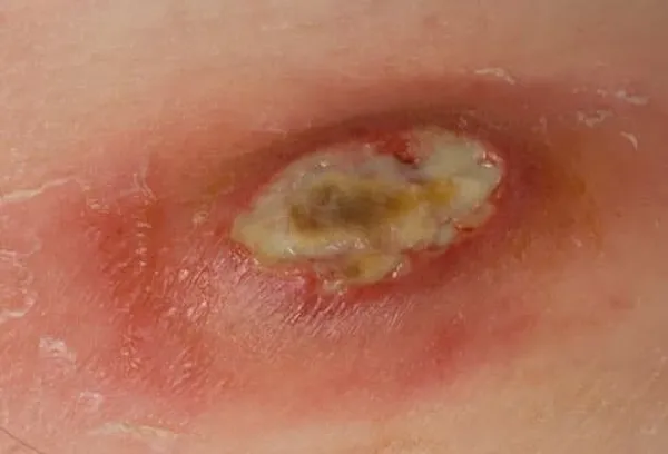 Is it a boil or mrsa