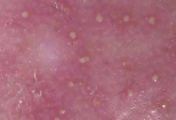 Image of folliculitis