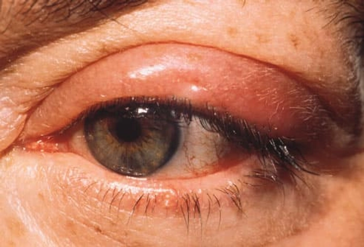 Boil Type: Stye