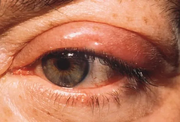 Sty on eye