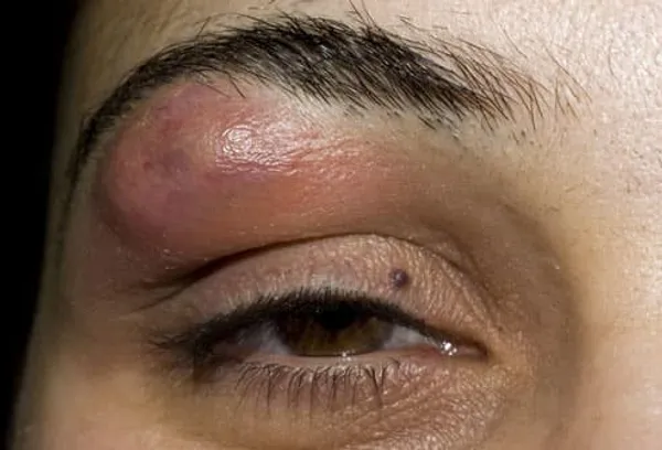 Boil on eyebrow