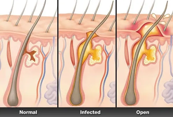 Illustration of boils