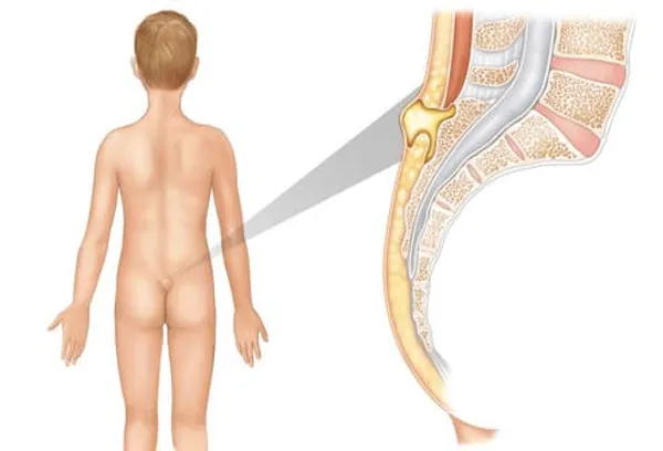 Illustration of pilonidal abscess
