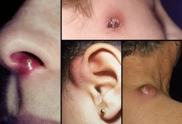 Locations of boils on body