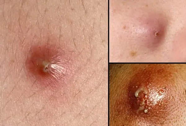 Symptoms of boils