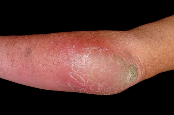 Septic Bursitis Septic Bursitis