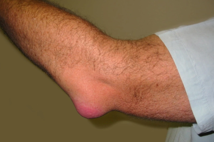 Elbow Bursitis Elbow Bursitis