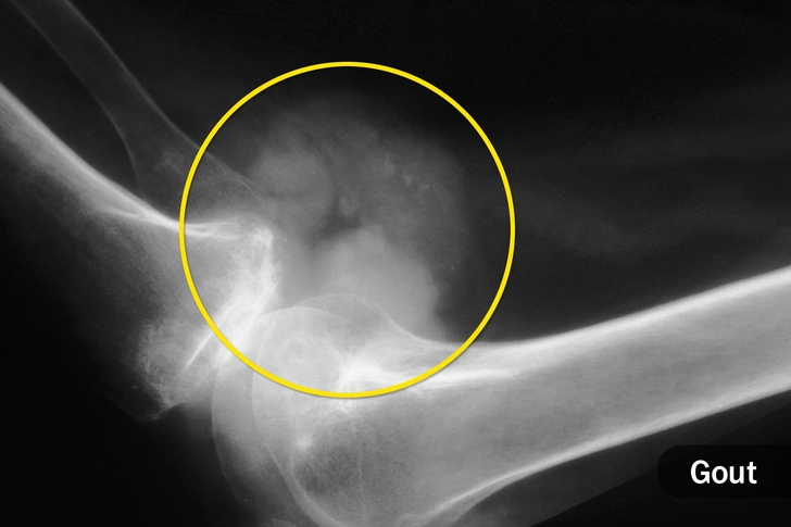 Acute Bursitis Acute Bursitis