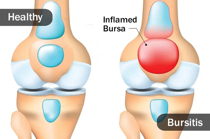 What Is Bursitis? What Is Bursitis?