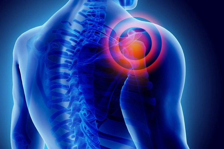 Shoulder Bursitis Shoulder Bursitis