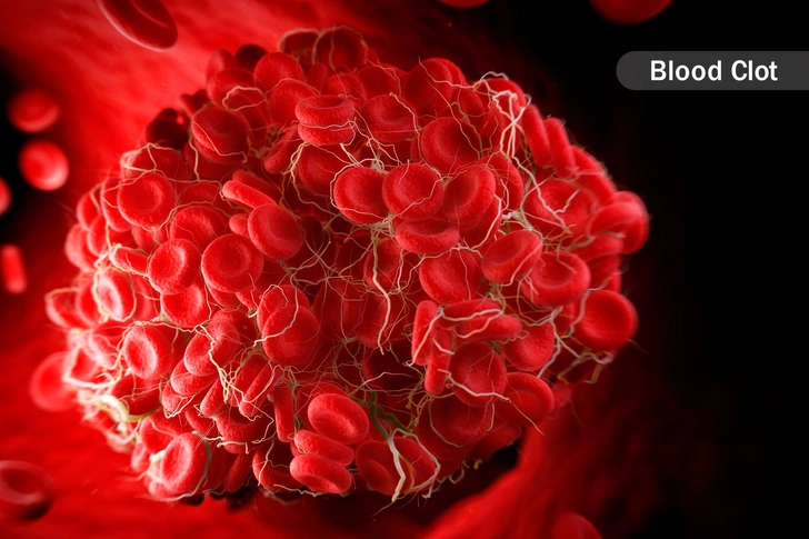 Causes: Clots, Genetics, and More