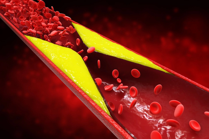 What Causes Claudication?