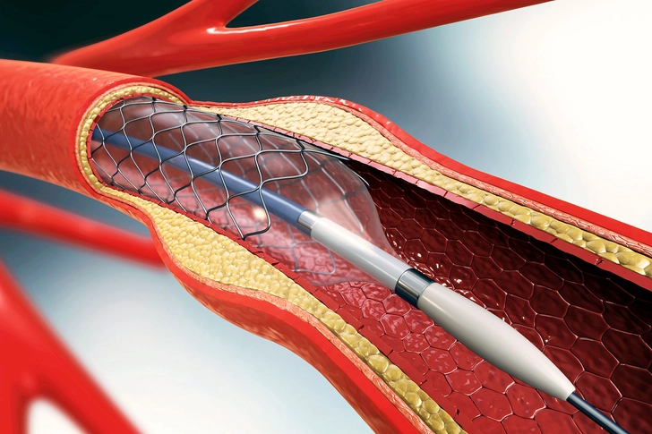 Are There Surgical Treatments for CAD?