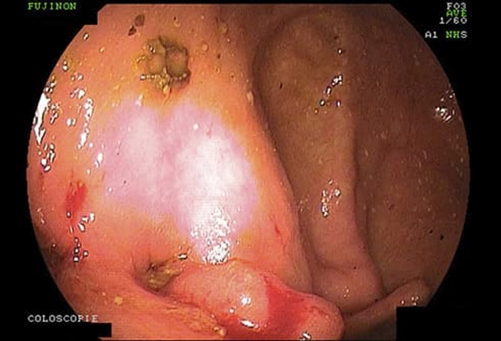 How Is It Diagnosed? How Is It Diagnosed?