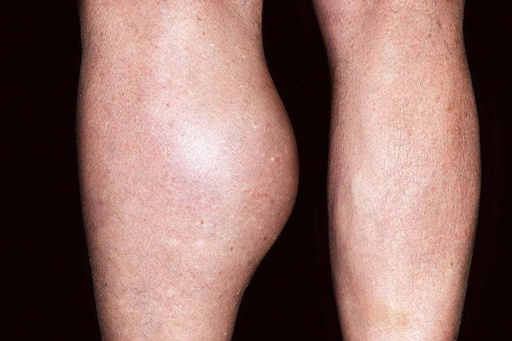 Baker’s Cyst