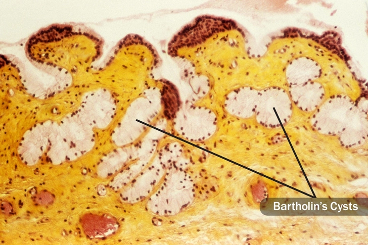 Bartholin's Cyst