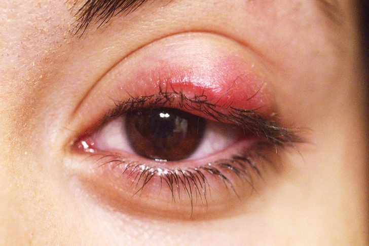 Chalazion Chalazion