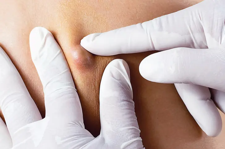 Cysts on Skin: Pictures of What They Look Like