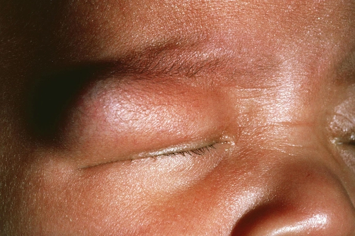 Dermoid Cyst Dermoid Cyst