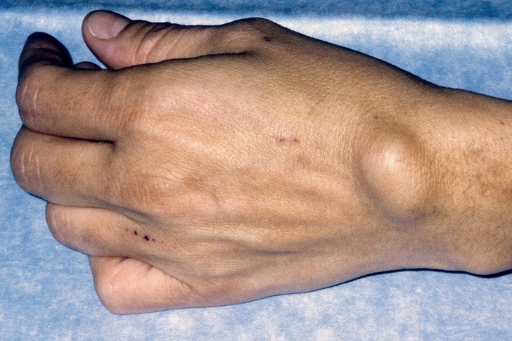 Ganglion Cyst Ganglion Cyst