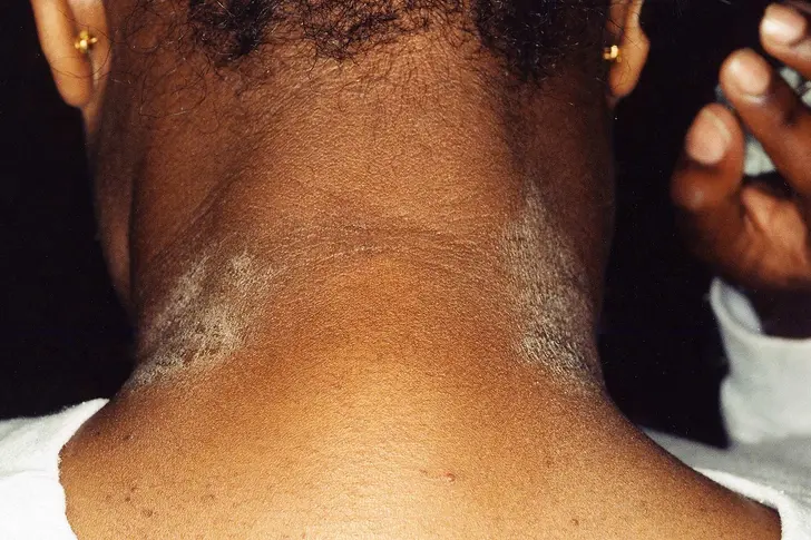 What Is Eczema? What Is Eczema?