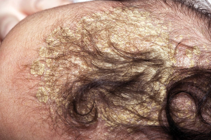 Is It Cradle Cap?