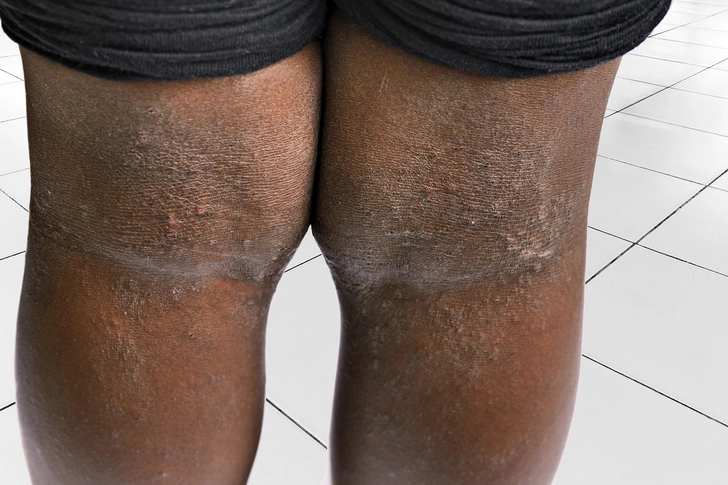 Eczema in Children Eczema in Children
