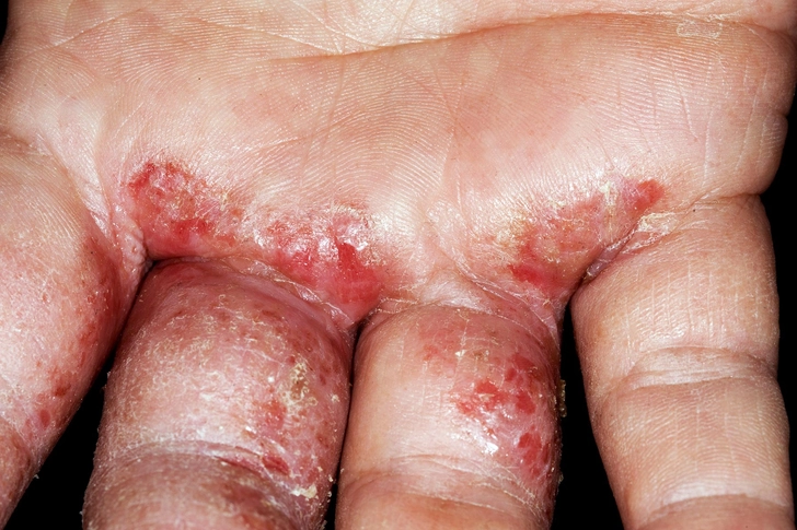 Hand Eczema Hand Eczema