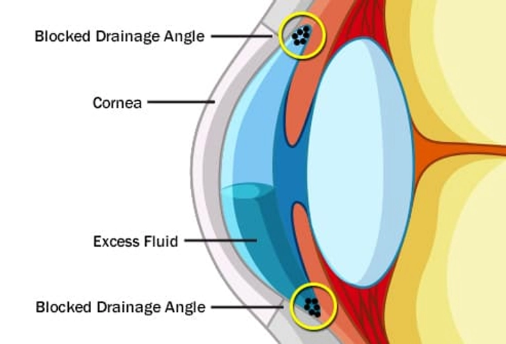 What Causes Glaucoma? What Causes Glaucoma?