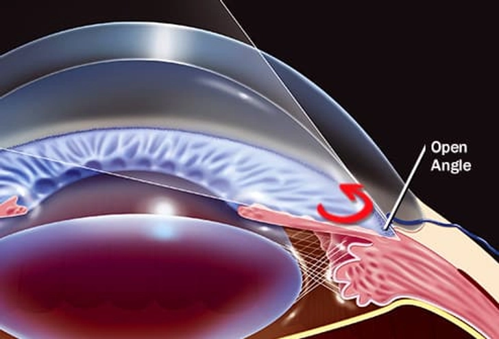 Types of Glaucoma: Open-Angle Types of Glaucoma: Open-Angle