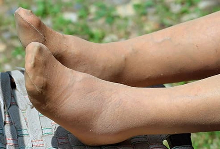 Symptom: Swelling and Weight Gain