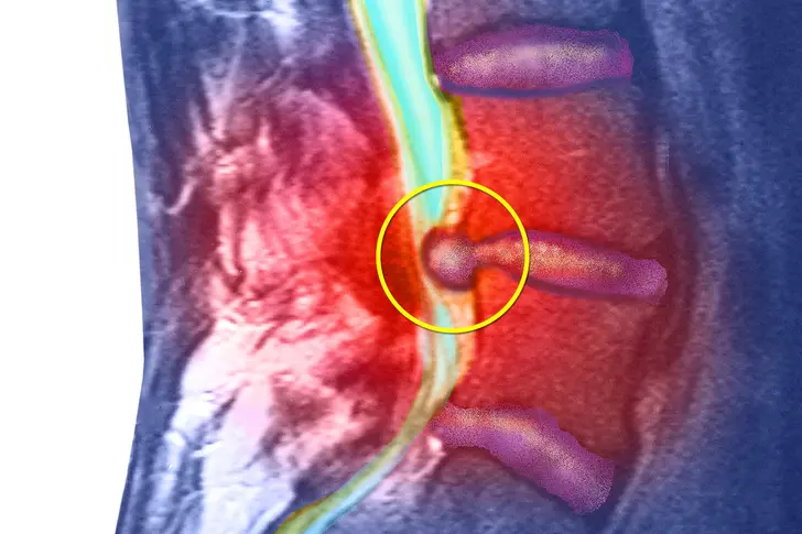 What Is a Herniated Disk? What Is a Herniated Disk?