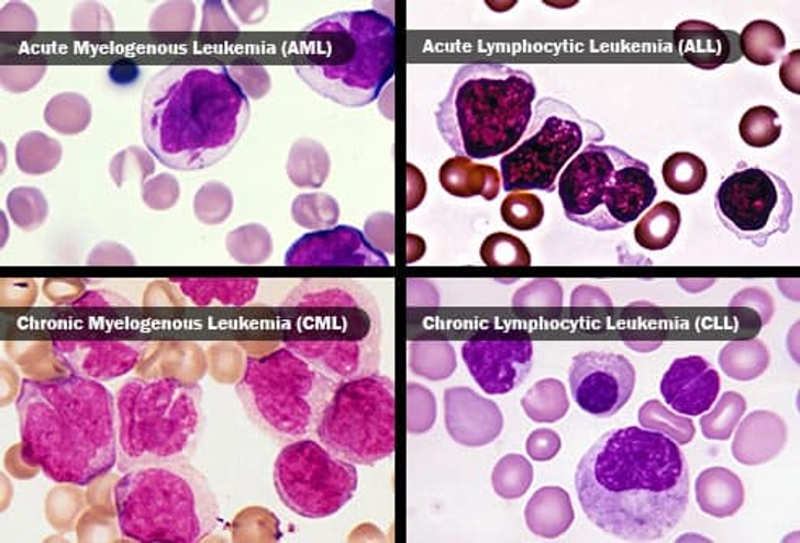 Common Types of Leukemia Common Types of Leukemia