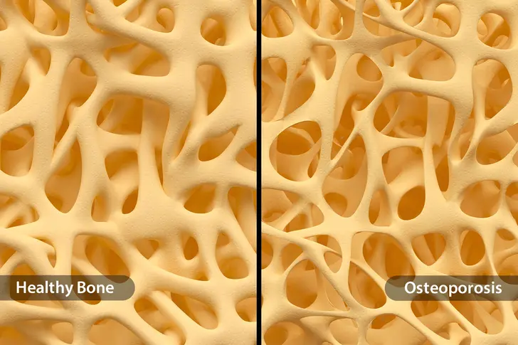 What Is Osteoporosis?