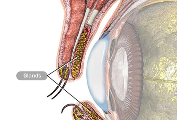 What Causes a Chalazion? What Causes a Chalazion?