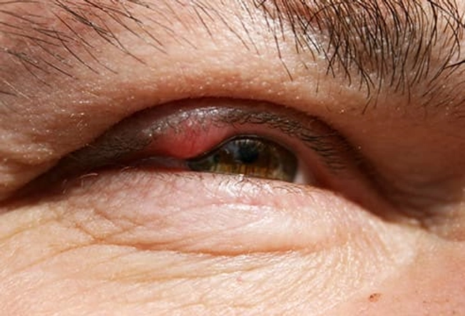 What Is a Chalazion?