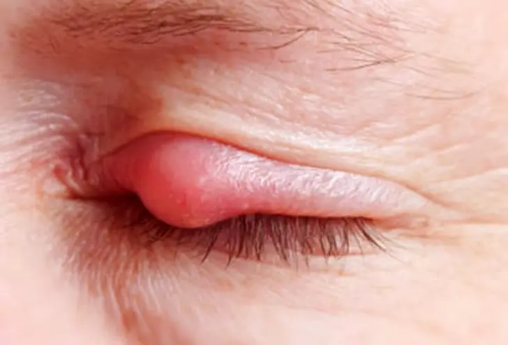 What Is a Stye?