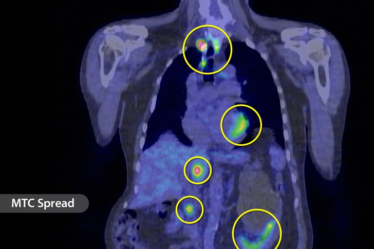 Medullary Thyroid Cancer (MTC) Medullary Thyroid Cancer (MTC)