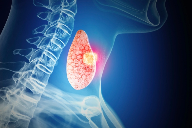 Nodule on Your Thyroid