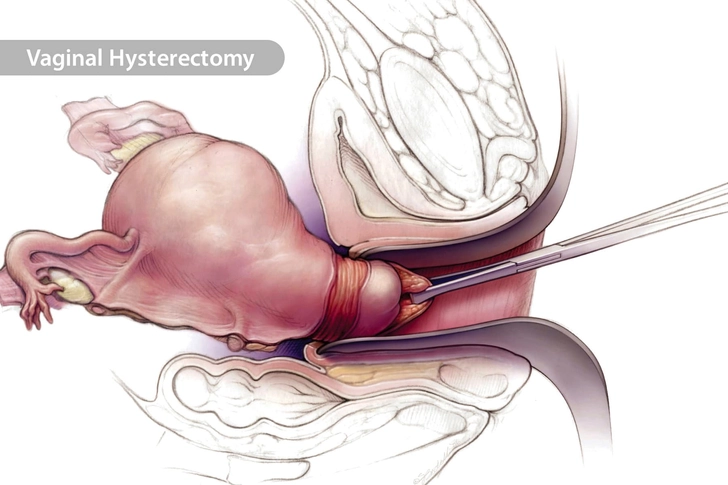 Hysterectomy Hysterectomy